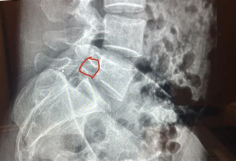 L5 pars fracture, grade 1 spondylolisthesis L5-S1. : r/Spondylolisthesis