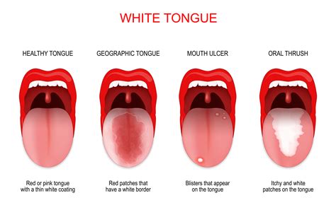 What Does It Mean To Have A White Film On Your Tongue at Wilbur Pritt blog