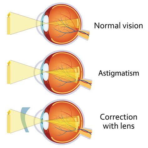 Astigmatism: ce este astigmatismul si cum se poate trata?