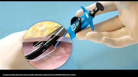 Image result for Perclose Device Tutorial