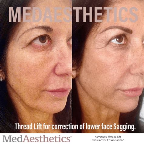 Image result for Thread Removal