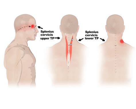 Splenius 的图像结果