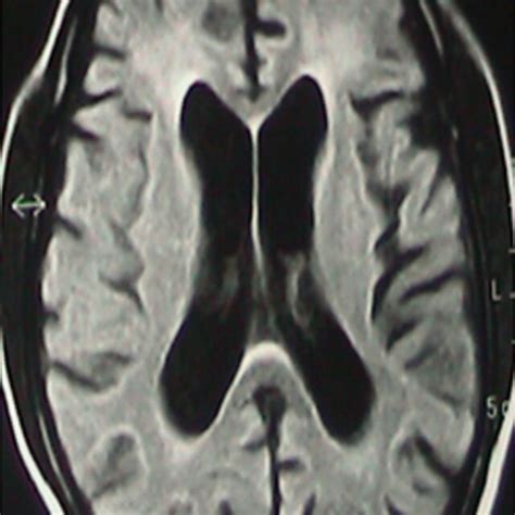 Image result for Diffuse Atrophy