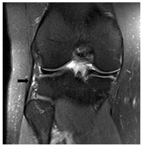 Fibular Collateral Ligament Mri