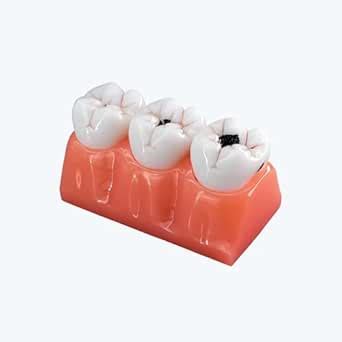 LABZIO by EISCO - Staged Model of Decaying Tooth, Removable and ...