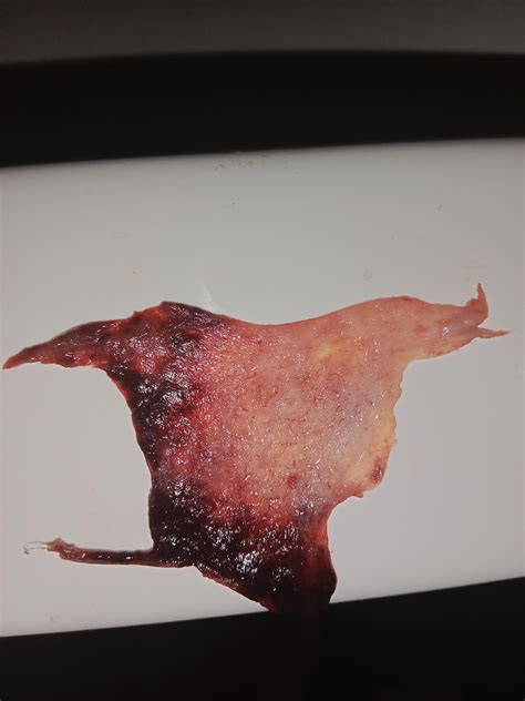 Decidual cast : r/MedicalGore