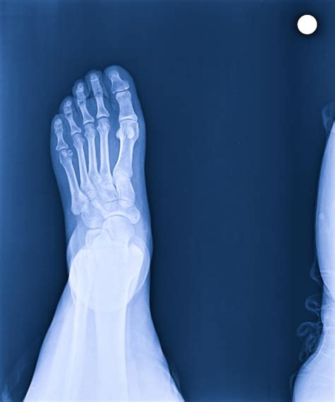 Normal Foot 的图像结果