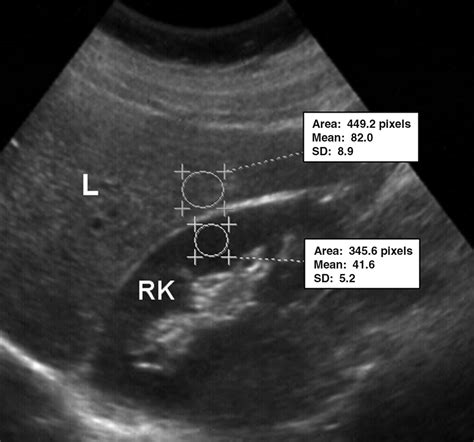 Computer-Assisted Ultrasound Analysis of Liver Echogenicity in Obese and Normal-Weight Children ...