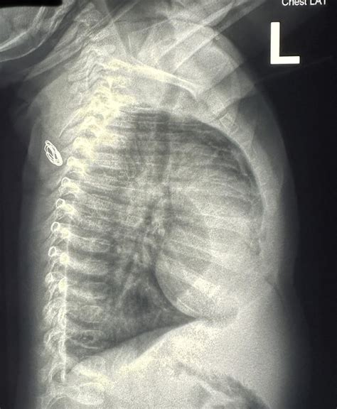 “Equal breath sounds bilaterally” : r/Radiology