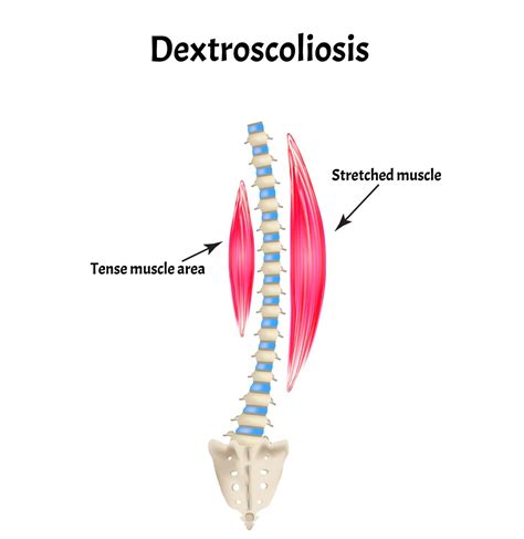 Levoscoliosis And Dextroscoliosis: How Are They Different? | New Jersey ...