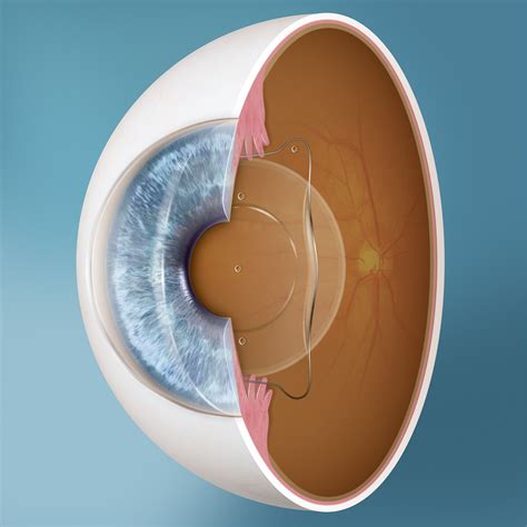 Implantable Contact Lens