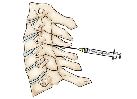 Image result for Fluoro Spinal Injection
