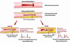 Image result for Ischemia