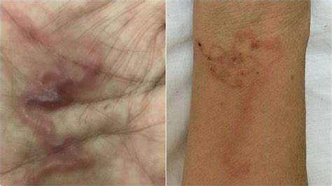 Parasites found under Vietnam woman's skin after she ate raw blood ...