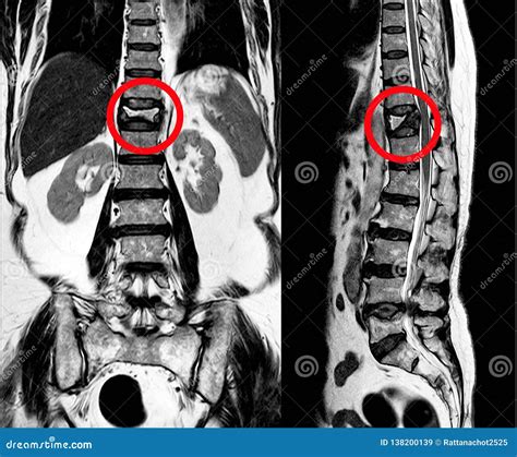 MRI Thoracic Lumbar Spine Show Moderate Pathological Compression Fracture of T12 Level Stock ...