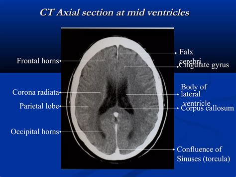 Radiological anatomy & Techniques of the Ventricular system | PPT