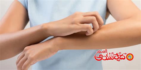 Ayurvedic Treatment for Psoriasis | Symptoms, Causes, Diagnosis