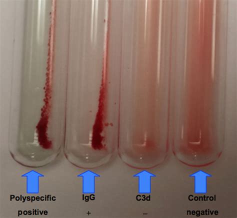Image result for Positive Dat Test Under Microscope