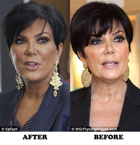 Kris Jenner Plastic Surgery Before and After Botox and new Facelift