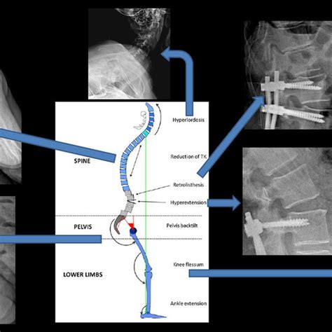 Image result for Compensatory Movement Examples
