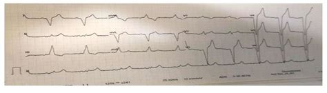 Fig. 2: Here ECG we can observe completely decrease the heart contractions