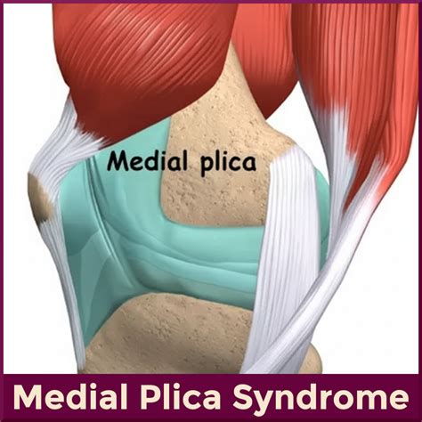 Medial Plica Syndrome