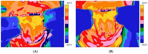 Thermal Imaging of Tongue Surface as a Prognostic Method in the ...