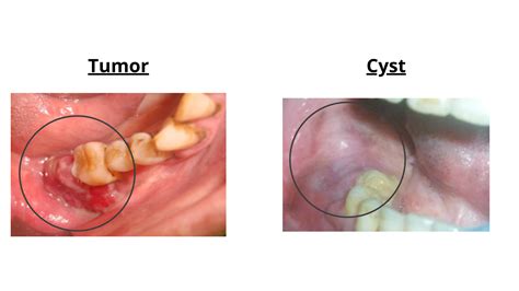 Wisdom Tooth Cyst Removal 的图像结果