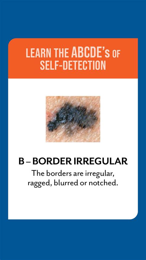 The abcdes skin cancer assessment – Artofit