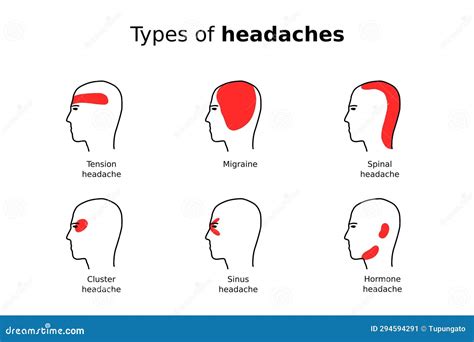 Types of Headaches Vector Infographic Stock Vector - Illustration of tension, design: 294594291