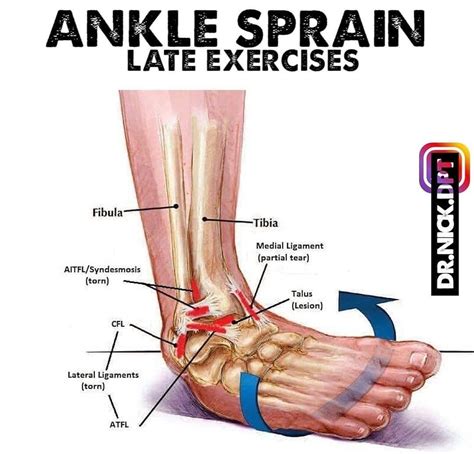 How to quickly heal a sprained ankle – Artofit