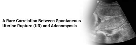 A rare correlation between Spontaneous Uterine Rupture (UR) and Adenomyosis
