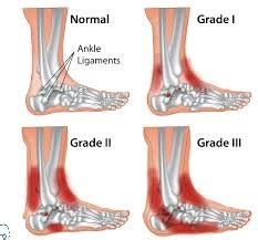 Sprained Ankle: Cause, Types, Diagnosis, Treatment & Drugs » How To Relief
