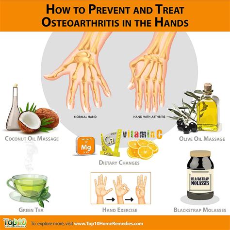 How to Prevent and Treat Osteoarthritis in the Hands | Top 10 Home Remedies