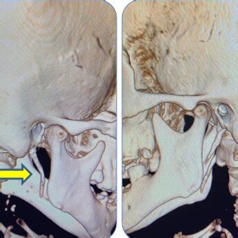 Image result for Styloid Process of Temporal Bone Attached