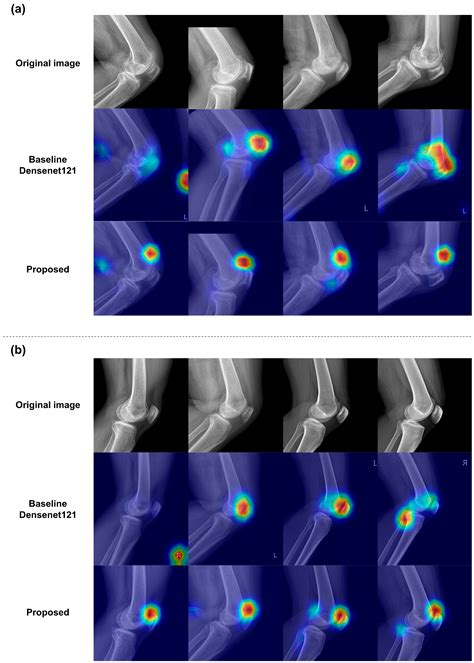 Deep Learning-Based Joint Effusion Classification in Adult Knee ...
