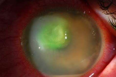 Ulcer On Eye Fungal Corneal Ulcer After Repair Of An Overhanging