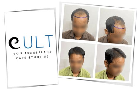 Hair Transplant Results 53 | Cult Aesthetics