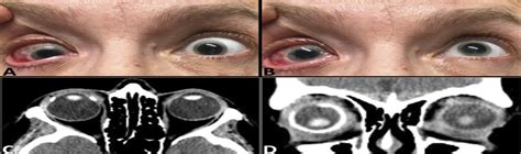 Image result for Intractable Diplopia