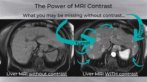 Mri And Contrast