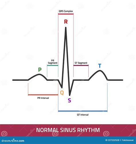 EKG Showing Normal Heartbeat Wave. ECG of Normal Sinus Rhythm ...