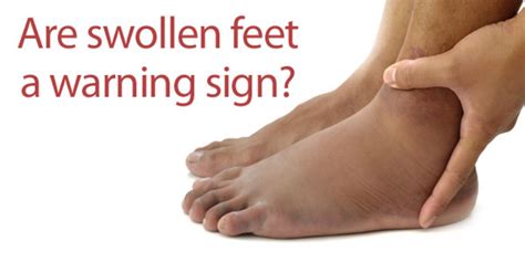 FootSmart Blog » How Serious Are Swollen Feet? | Swollen feet, Swelling ...