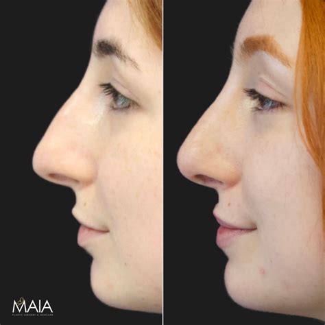 Septoplasty Before And After