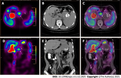 Pancreatic neuroendocrine tumor detected by technetium-99m methoxy-2-isobutylisonitrile single ...