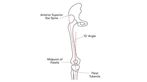 A Leg-Activating Sequence to Address Common Misalignments