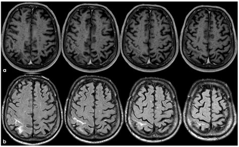 Clinical and Neuroradiological Manifestations of Cerebral Amyloid ...