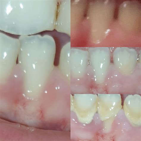 Tooth Recession 的图像结果