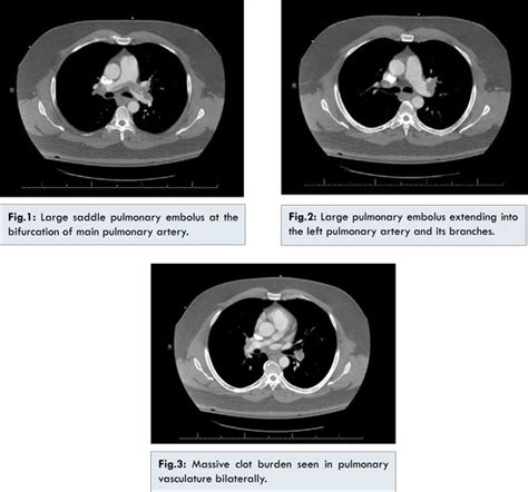 Unprovoked Saddle Pulmonary Embolism in a Patient with Shy-Drager ...