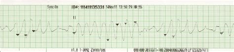 Image result for Synchronized Cardioversion Rhythm Strip