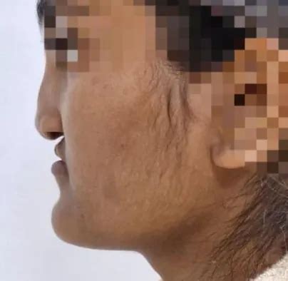 LeFort Osteotomy in Lucknow | Upper Jaw Surgery Kayakriti